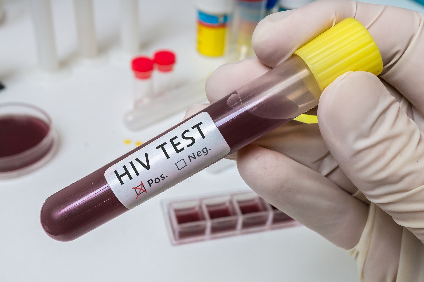 Komórki macierzyste z krwi pępowinowej wyleczyły chorą zakażoną wirusem HIV