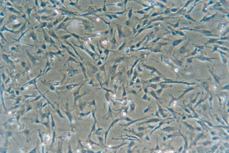Pierwszy w Polsce zabieg przeszczepienia komórek macierzystych w padaczce lekoopornej o podłożu autoimmunologicznym