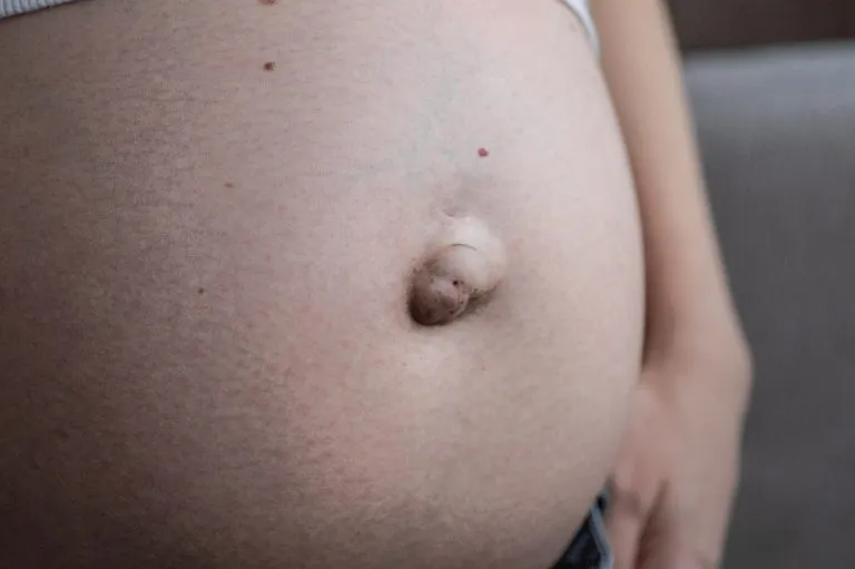 Umbilical hernia in pregnancy